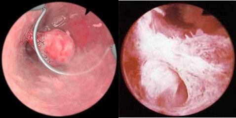宫腔镜下宫内膜息肉摘除(左)