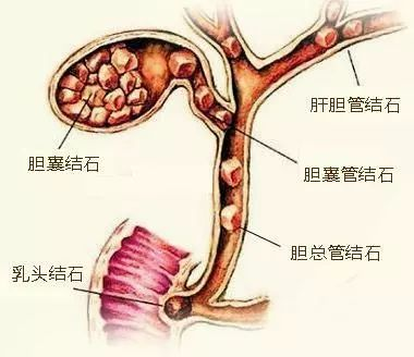 关于胆囊结石肝囊肿你了解多少？