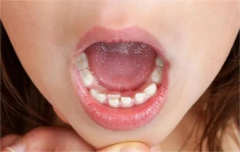 孩子长了“双层牙”究竟该如何是好？