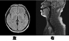颈部淋巴血管吻合(LVA)治疗帕金森综合征