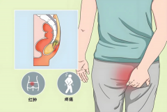 高位挂线结合深部置管引流术治疗肛周脓肿