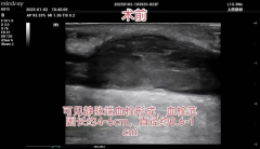 球囊扩张成形术解决内瘘血栓及狭窄问题