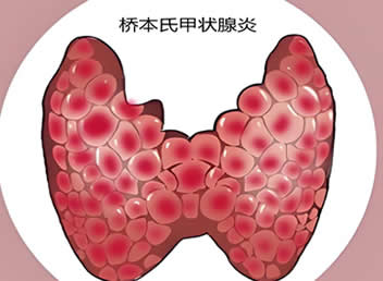 桥本甲状腺炎的诊断