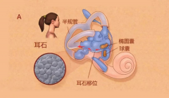 得了耳石症看诊什么科