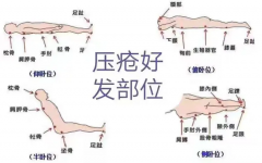 压力性损伤易发部位