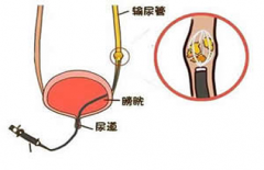 如何排出尿路里的结石呢?