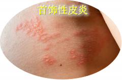 出现“首饰性皮炎”怎么办?
