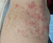 为什么糖友更需要警惕带状疱疹?