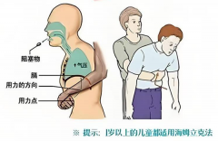 黄金4分钟！学会气道阻塞急救，关键时刻能救命
