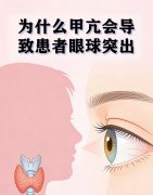 甲亢会导致眼球突出吗