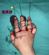 内固定克氏针取出注意事项