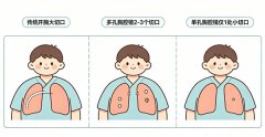 单孔胸腔镜到底是种什么手术?
