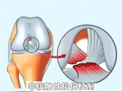 跟拍“闪身步”致前交叉韧带损伤